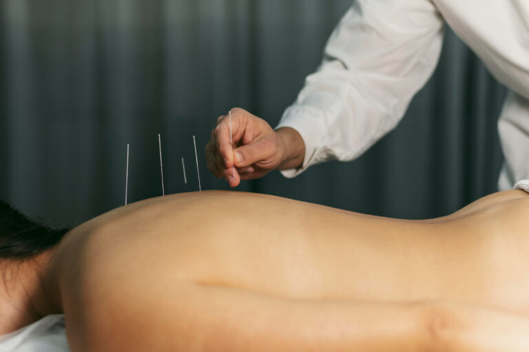 Dry Needling Therapy in Physiotherapy – Pain Relief, Muscle Recovery & Treatment in Dubai